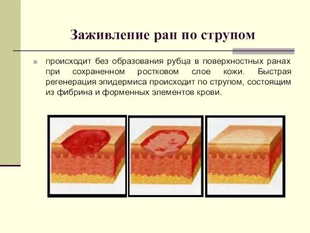 Заживление ран по струпом происходит без образования рубца в поверхностных ранах при