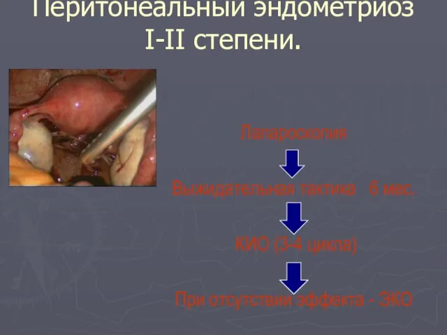 Перитонеальный эндометриоз I-II степени. Лапароскопия Выжидательная тактика 6 мес. КИО (3-4 цикла)