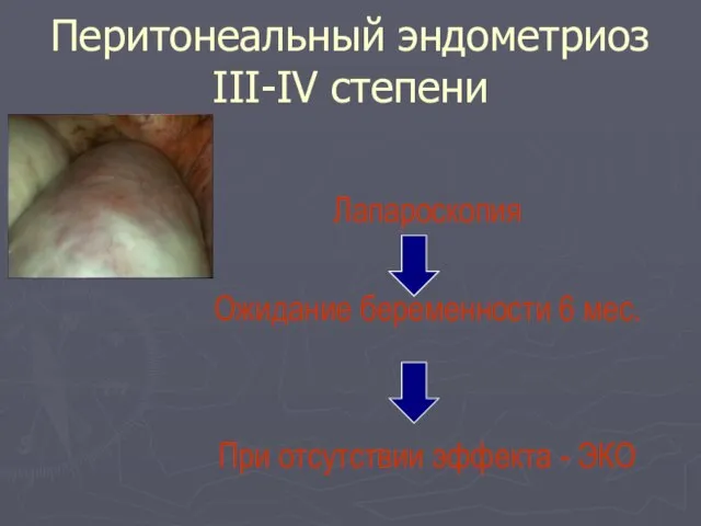 Перитонеальный эндометриоз III-IV степени Лапароскопия Ожидание беременности 6 мес. При отсутствии эффекта - ЭКО