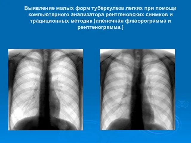 Выявление малых форм туберкулеза легких при помощи компьютерного анализатора рентгеновских снимков и