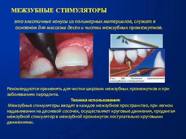 МЕЖЗУБНЫЕ СТИМУЛЯТОРЫ это эластичные конусы из полимерных материалов, служат в основном для