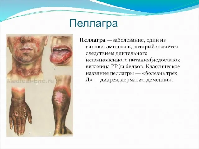 Пеллагра Пеллагра —заболевание, один из гиповитаминозов, который является следствием длительного неполноценного питания(недостаток