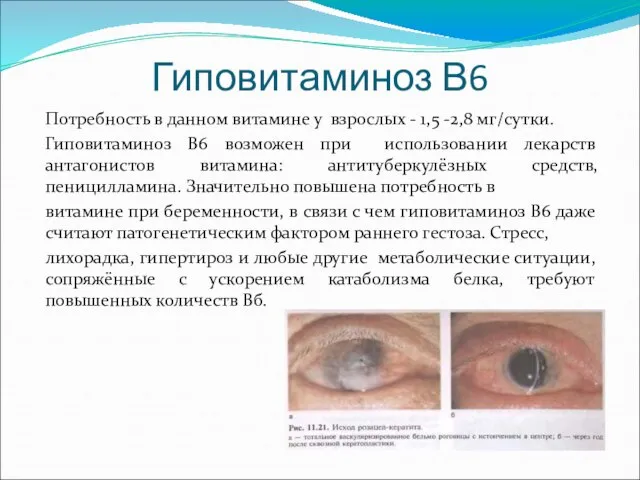 Гиповитаминоз В6 Потребность в данном витамине у взрослых - 1,5 -2,8 мг/сутки.