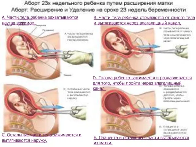 А. Части тела ребенка захватываются наугад зажимом. В. Части тела ребенка отрываются