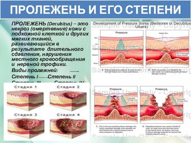 ПРОЛЕЖЕНЬ И ЕГО СТЕПЕНИ ПРОЛЕЖЕНЬ (Decubitus) – это некроз (омертвение) кожи с