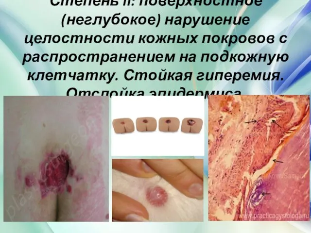 Степень II: поверхностное (неглубокое) нарушение целостности кожных покровов с распространением на подкожную