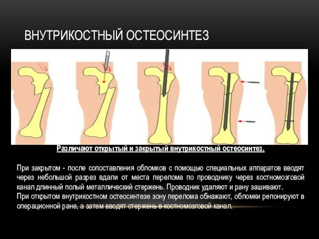 Внутрикостный остеосинтез Различают открытый и закрытый внутрикостный остеосинтез. При закрытом - после