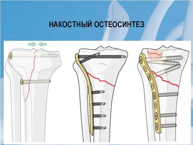 Накостный остеосинтез Костные фрагменты устанавливают в заданном положении, добиваясь точного сопоставления их