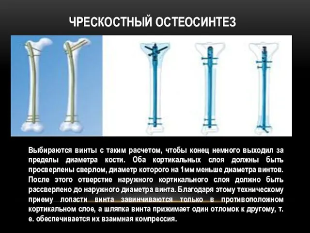 Чрескостный остеосинтез Выбираются винты с таким расчетом, чтобы конец немного выходил за