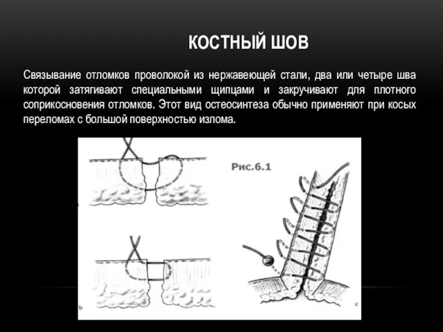 Костный шов Связывание отломков проволокой из нержавеющей стали, два или четыре шва