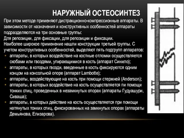 Наружный остеосинтез При этом методе применяют дистракционно-компрессионные аппараты. В зависимости от назначения