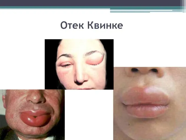 Отек Квинке