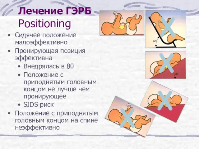 Лечение ГЭРБ Positioning Сидячее положение малоэффективно Пронирующая позиция эффективна Внедрялась в 80