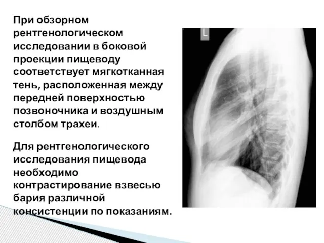 При обзорном рентгенологическом исследовании в боковой проекции пищеводу соответствует мягкотканная тень, расположенная