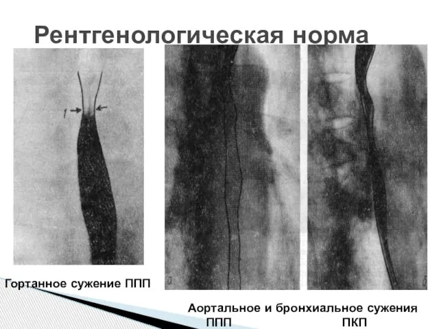 Рентгенологическая норма Гортанное сужение ППП Аортальное и бронхиальное сужения ППП ПКП