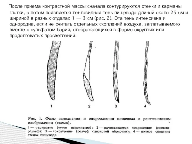 После приема контрастной массы сначала контурируются стенки и карманы глотки, а потом