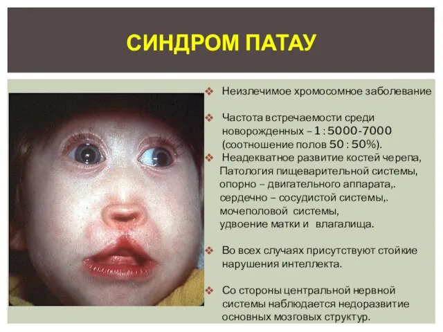 Синдром Патау Неизлечимое хромосомное заболевание Частота встречаемости среди новорожденных – 1 :