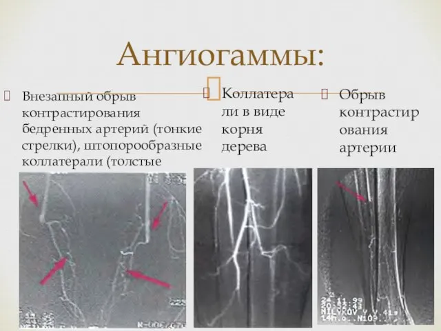 Внезапный обрыв контрастирования бедренных артерий (тонкие стрелки), штопорообразные коллатерали (толстые стрелки). Ангиогаммы: