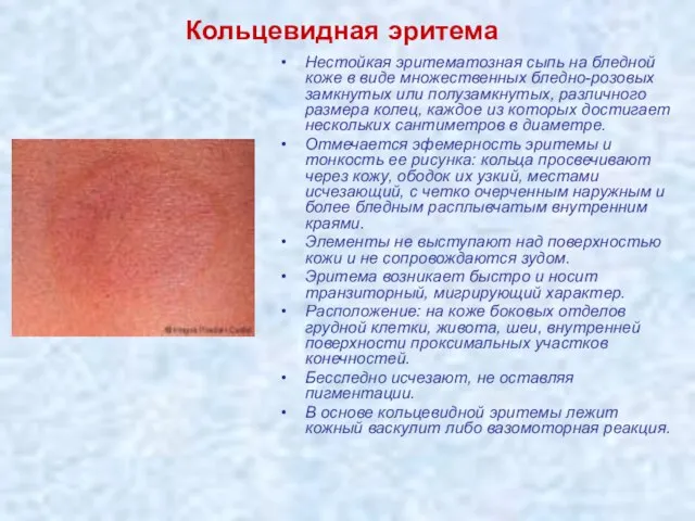 Кольцевидная эритема Нестойкая эритематозная сыпь на бледной коже в виде множественных бледно-розовых
