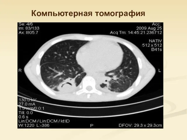 Компьютерная томография