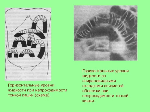 Горизонтальные уровни жидкости при непроходимости тонкой кишки (схема). Горизонтальные уровни жидкости со