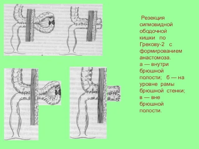 Резекция сигмовидной ободочной кишки по Грекову-2 с формированием анастомоза. а — внутри