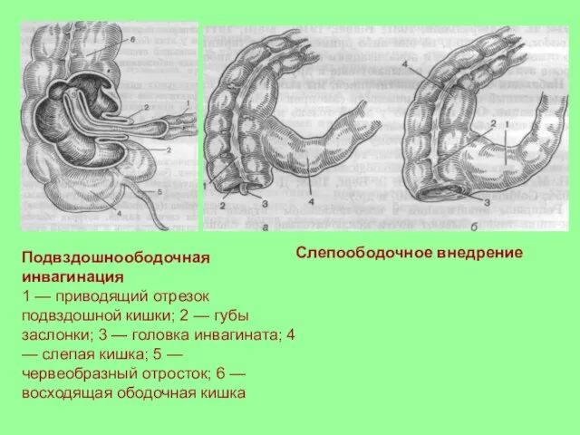 Подвздошноободочная инвагинация 1 — приводящий отрезок подвздошной кишки; 2 — губы заслонки;