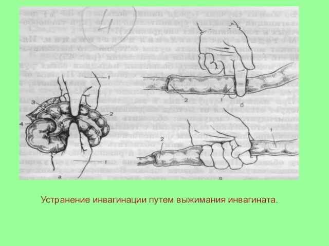 Устранение инвагинации путем выжимания инвагината.