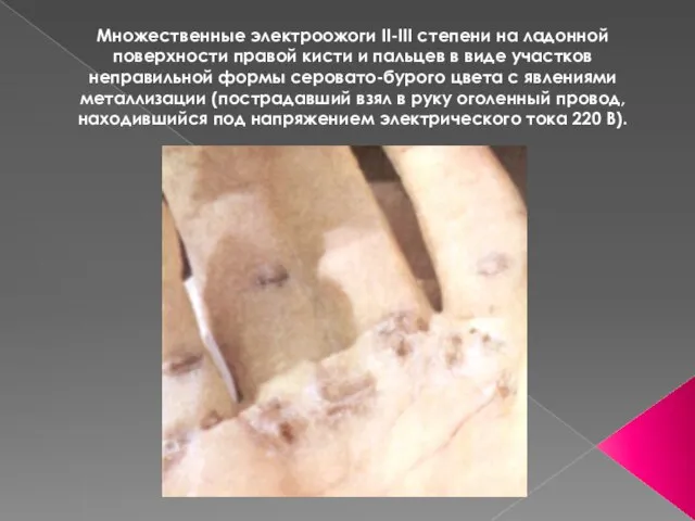 Множественные электроожоги II-III степени на ладонной поверхности правой кисти и пальцев в