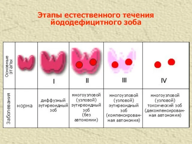 Этапы естественного течения йододефицитного зоба