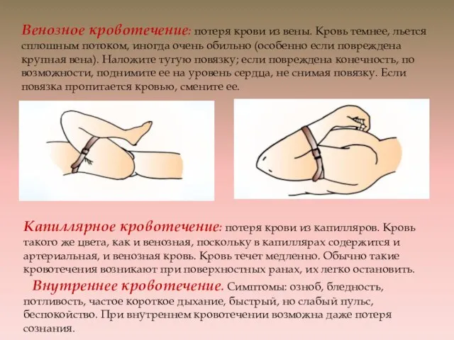 Венозное кровотечение: потеря крови из вены. Кровь темнее, льется сплошным потоком, иногда