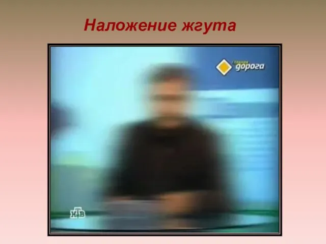 Наложение жгута