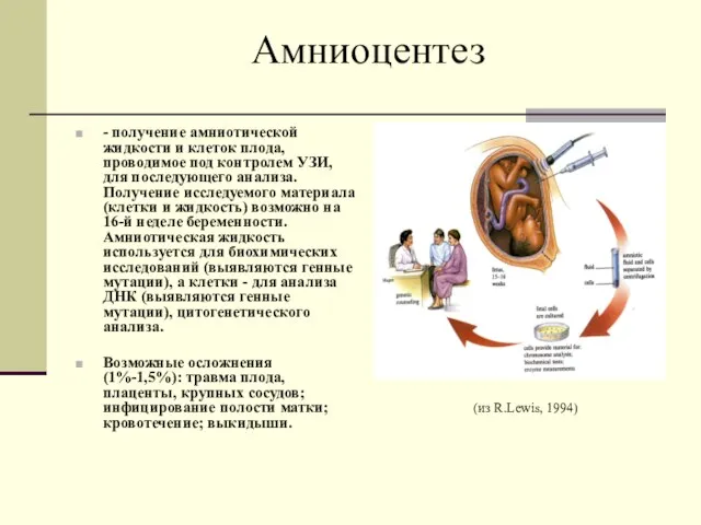 Амниоцентез - получение амниотической жидкости и клеток плода, проводимое под контролем УЗИ,