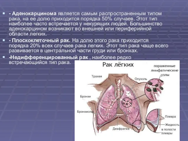 - Аденокарцинома является самым распространенным типом рака, на ее долю приходится порядка