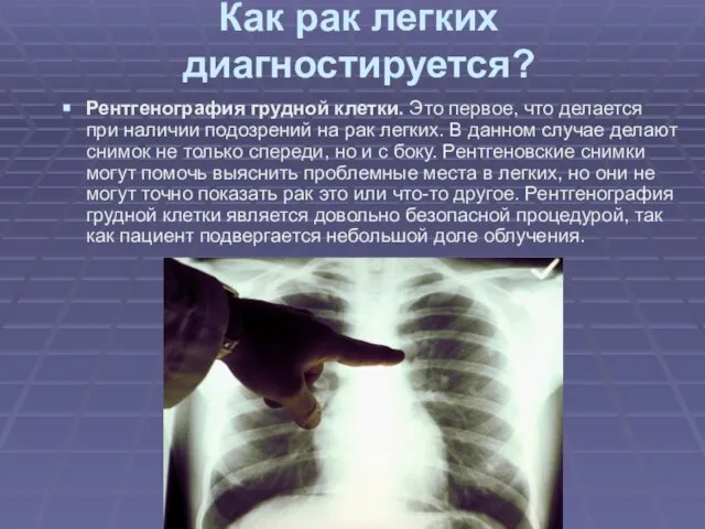 Как рак легких диагностируется? Рентгенография грудной клетки. Это первое, что делается при