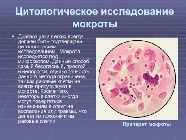 Цитологическое исследование мокроты Диагноз рака легких всегда должен быть подтвержден цитологическим исследованием.