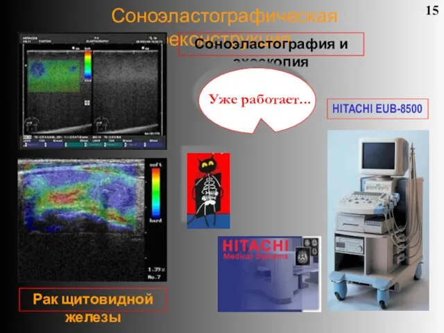 Соноэластографическая реконструкция 15 Соноэластография и эхоскопия Рак щитовидной железы