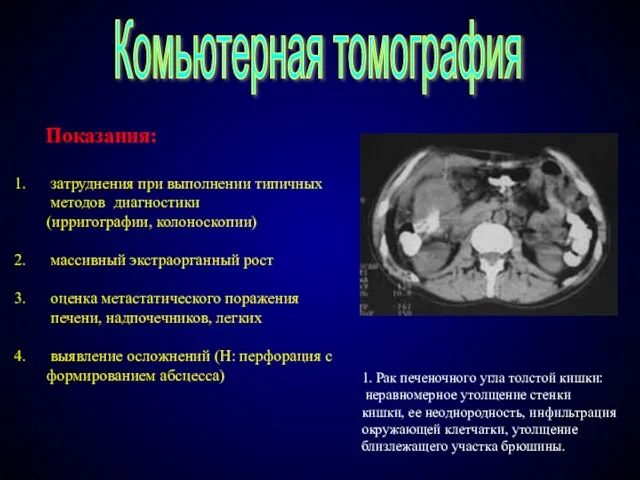 Комьютерная томография Показания: затруднения при выполнении типичных методов диагностики (ирригографии, колоноскопии) массивный