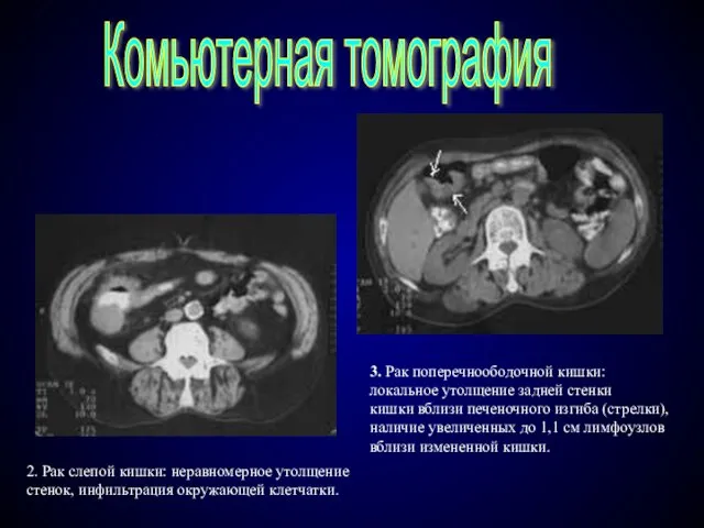 Комьютерная томография 2. Рак слепой кишки: неравномерное утолщение стенок, инфильтрация окружающей клетчатки.