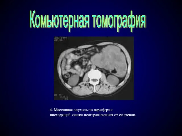 4. Массивная опухоль по периферии нисходящей кишки неотграниченная от ее стенок. Комьютерная томография