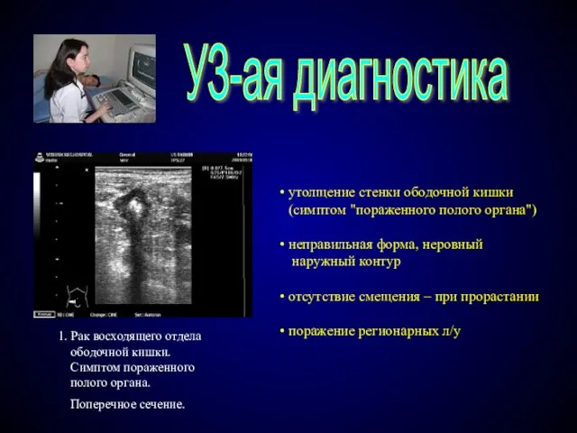 УЗ-ая диагностика 1. Рак восходящего отдела ободочной кишки. Симптом пораженного полого органа.