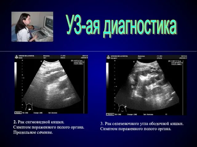 УЗ-ая диагностика 3. Рак селезеночного угла ободочной кишки. Симптом пораженного полого органа.