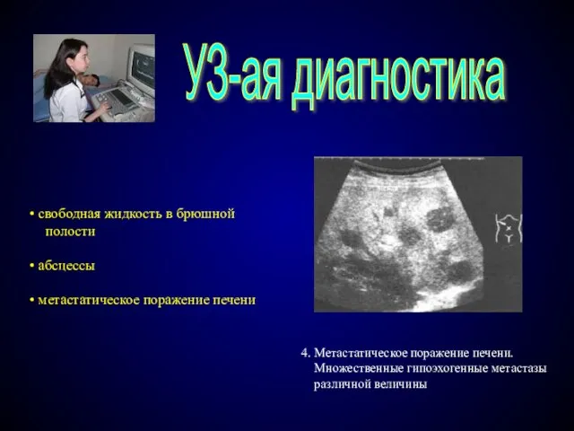 УЗ-ая диагностика 4. Метастатическое поражение печени. Множественные гипоэхогенные метастазы различной величины свободная