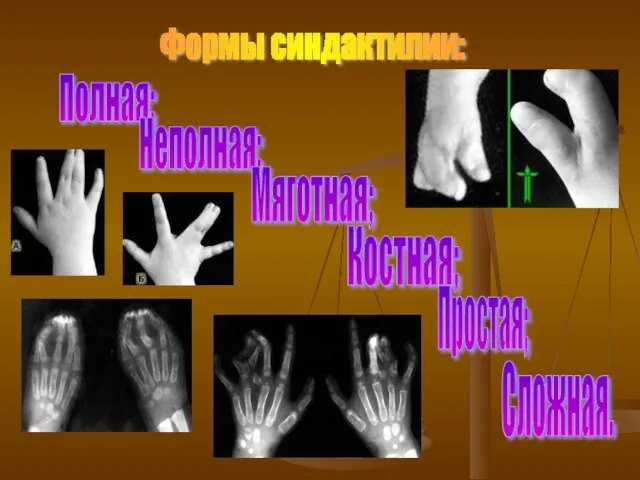 Формы синдактилии: Полная; Неполная; Мяготная; Костная; Простая; Сложная.