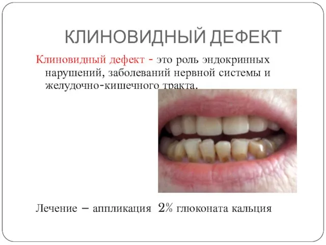 КЛИНОВИДНЫЙ ДЕФЕКТ Клиновидный дефект - это роль эндокринных нарушений, заболеваний нервной системы