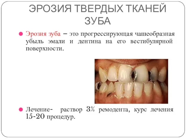 ЭРОЗИЯ ТВЕРДЫХ ТКАНЕЙ ЗУБА Эрозия зуба – это прогрессирующая чашеобразная убыль эмали