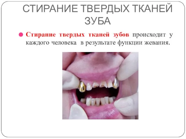 СТИРАНИЕ ТВЕРДЫХ ТКАНЕЙ ЗУБА Стирание твердых тканей зубов происходит у каждого человека в результате функции жевания.