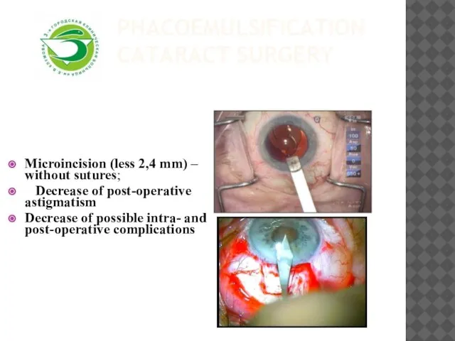 Phacoemulsification cataract surgery Microincision (less 2,4 mm) – without sutures; Decrease of