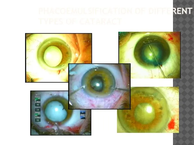 Phacoemulsification of different types of cataract