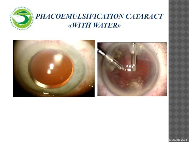 Phacoemulsification cataract «with water»